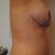 4 weeks post-op