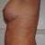 4 weeks post-op