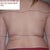 2 months post lipo = worse