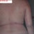 Day after.  The sagging was same day after as now at 10 wks