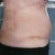 Day 15 PO still very swollen