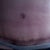 !0 weeks PostOp.  Scar is healing nicely.  It loves to be massaged!  I still have swelling around hip area.