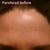Forehead before