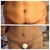 Before, and 2 days post op!