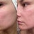 Here's a before and after - the after being six days later. This is my left cheek.
