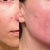 Here's a before and after - the after being six days later. This is my right cheek.