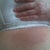 rash under right