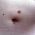 Belly button at 3 months.