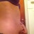 Before procedure side view - pinching fat