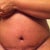 5 days post op, sorry for all the extra outside of stomach ladies. lol