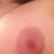 Scarring - I've been using Dermatix Ultra for approx. 1 week now.