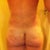 rear view. 14 days post op