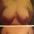 9.5 weeks vs. pre op surgeon comparison. 