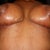 4 Weeks PO - the dreaded scar shot (under the boobs)