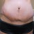 4 Weeks PO.  These panties only cover the lowest bit of the incision, like most of my panties.