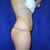 12 weeks post op at Dr's Office