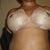 1 day post op