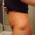 4 days po side