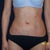 1 day after Smartlipo