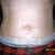 Day #5 post op tummy tuck front view