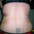 Day #5 post op tummy tuck back view