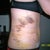 Day #5 post op tummy tuck side view