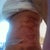 Holy bruises batman, no wonder Im in pain! lipo worse then tuck!