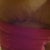 incision on right hip. 17 days.