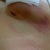 Some Bruising on Left Breast..