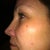 Just about 2 weeks after first photofacial. The large dark mark on the cheek bone I've had all my life and I'm keeping it.