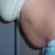 before surgery