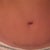 My scar at 3 months