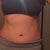 3 month post op