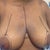 Getting ready for surgery looking at the indentions on my shoulders a lot of pain there