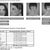 Chronic Migraine Botox Injection Sites