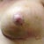 1 week post op left breast.