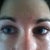 Another DURING TREATMENT photo. Eyes felt dry and often itchy. It was like the Hyaluronidase caused allergic symptoms for 2 weeks after each treatment. My eyes would water, but be dry and burning. Still puffy here after 5 months of Hyaluronidase injections, but overall bulging way reduced from what it was