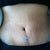 my tummy healing about 1 week and half in