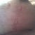 9 Weeks PO R Breast.  The white circle is where the hole was.  The other mark on the side of my boob is a mark my bra made. ;-)