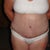 9 days post op....front view....keep in mind I am swollen