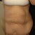 Preop. 100lb weight loss after 3 kids.