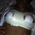 bandaged up