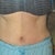37 days po (swelling is going down)