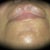 3rd treatment 9.2.09 (chin)