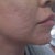 11.2 - left side (still very deep scars)