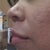 11.2 - Right Side (very visible scars)