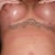 Scars 4 weeks post op of my lollipop lift.