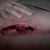 A couple months after - Fat necrosis - this is when it was looking better and getting better.  I have pics from when it was much worse, but I didn't think anyone would want to see them.  This doesn't hurt. I never felt any pain with this wound. 
