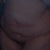 This is 14 months after surgery. The doc told me that he would repair this after it healed, then, he wanted me to pay MORE money to go to the OR to fix it.  It doesn't bother me or my husband, so we decided not to worry about it. 
