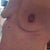 day 11...after dressings removed they look better...